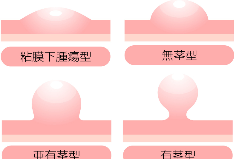 ポリープがあった場合の対応について